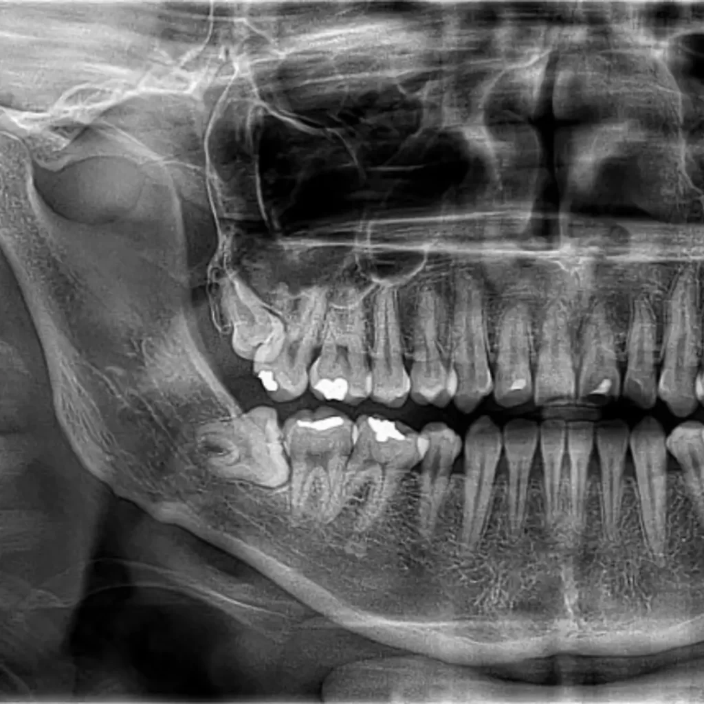 Extracciones de muelas del juicio en clinica en ñuñoa, mejores especialistas