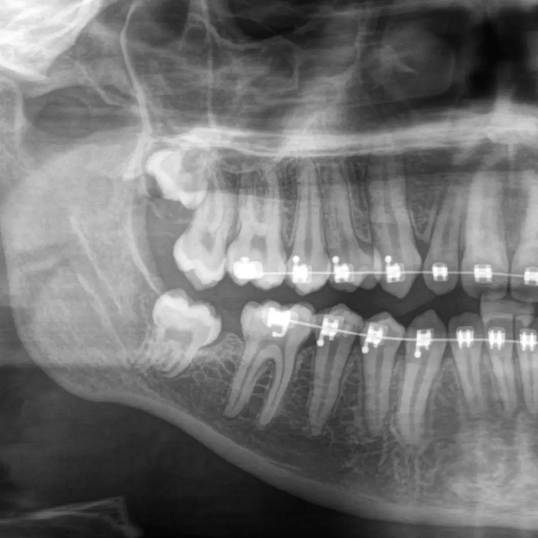 Extracción de muelas del juicio en ñuñoa en clínica dental enamel
