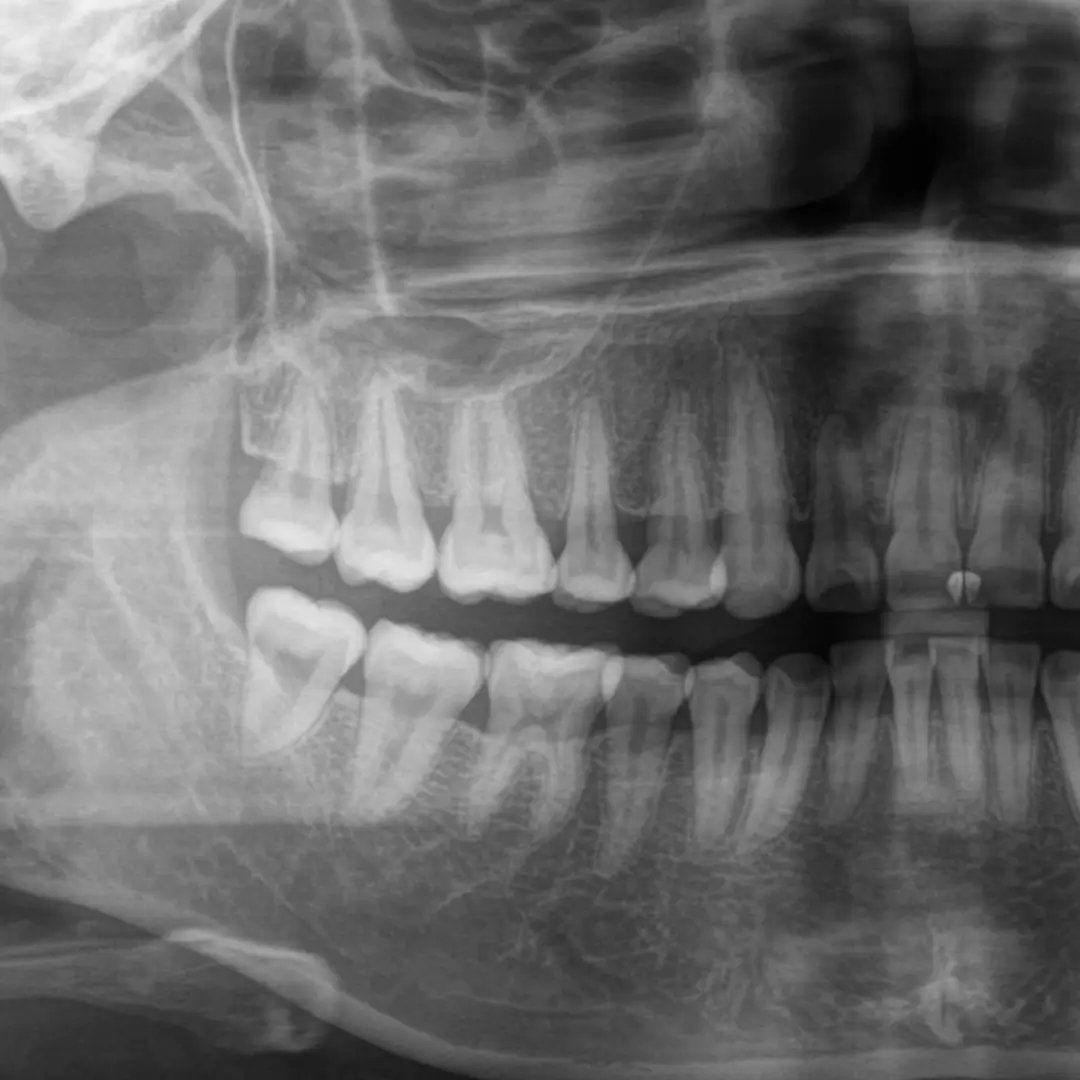 mejor odontólogo para extraer muelas del juicio