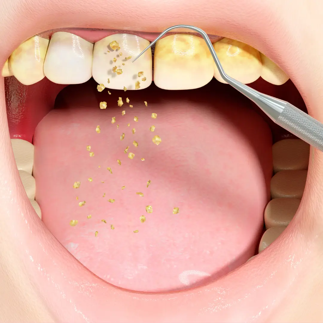 Precio limpieza dental en Ñuñoa – Clínica Enamel