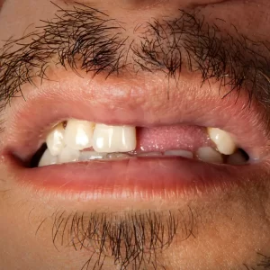 sin diente-implantologia-Clínica dental Enamel en Ñuñoa , cerca del metro plaza Egaña