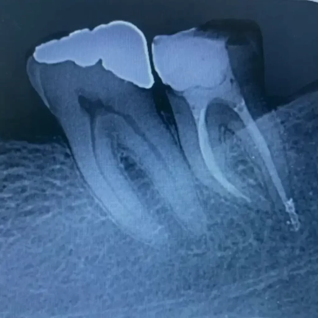 ENAMEL-ENDODONCIA