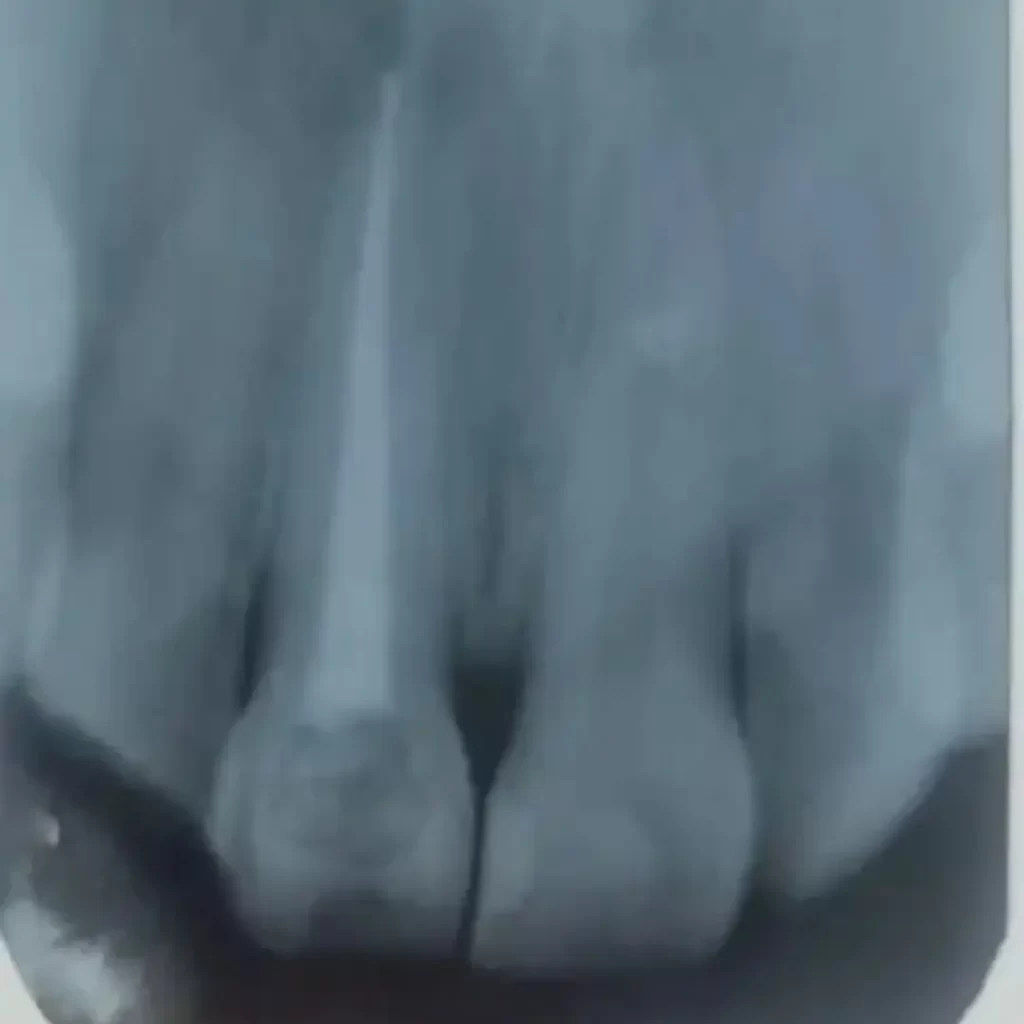 Tratamiento de conducto en Enamel