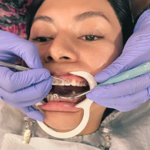 instalación de ortodoncia en clínica dental enamel en ñuñoa