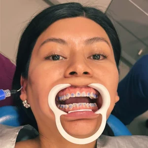 Ortodoncia rápida-enamel