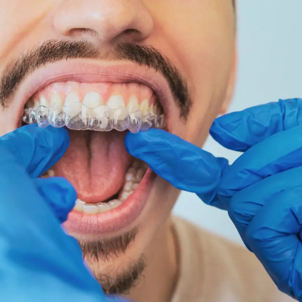 Ortodoncia removible - Clínica Enamel