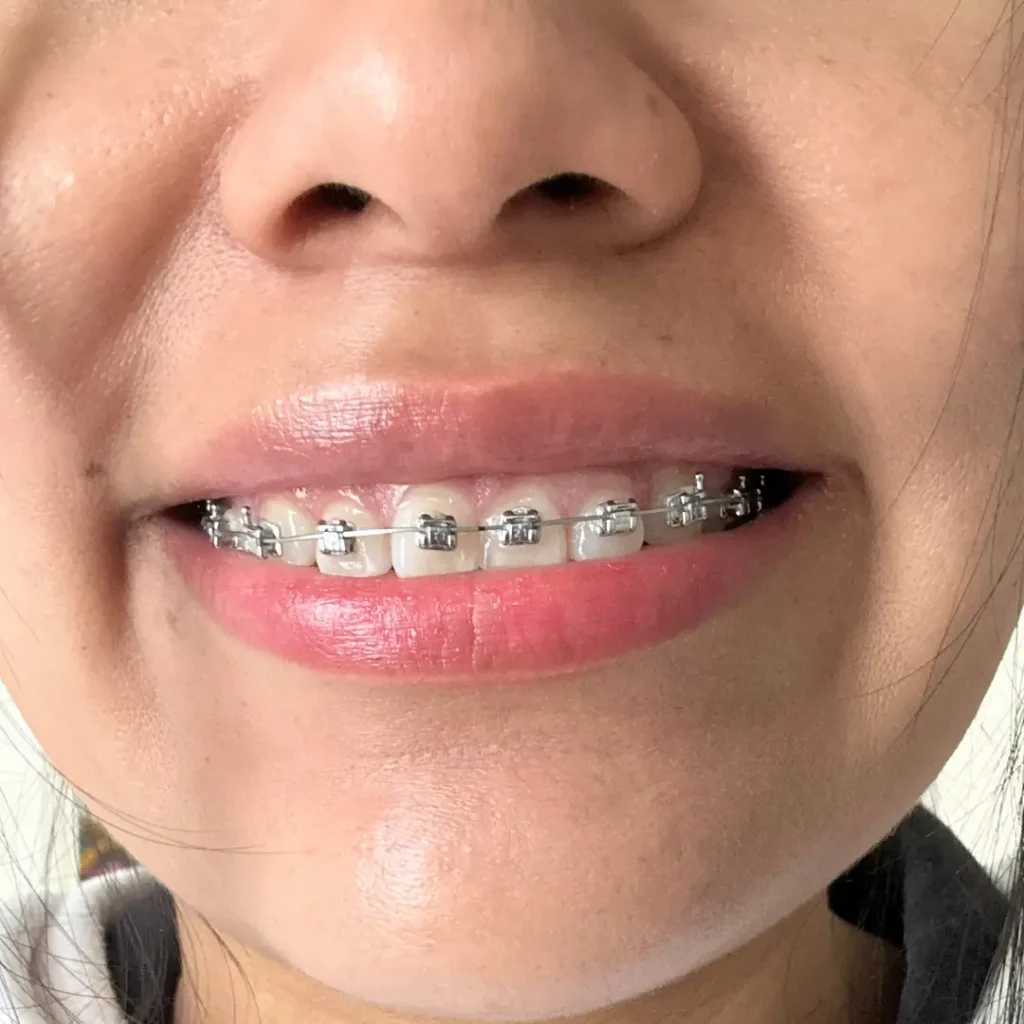 ortodoncia rápida Enamel