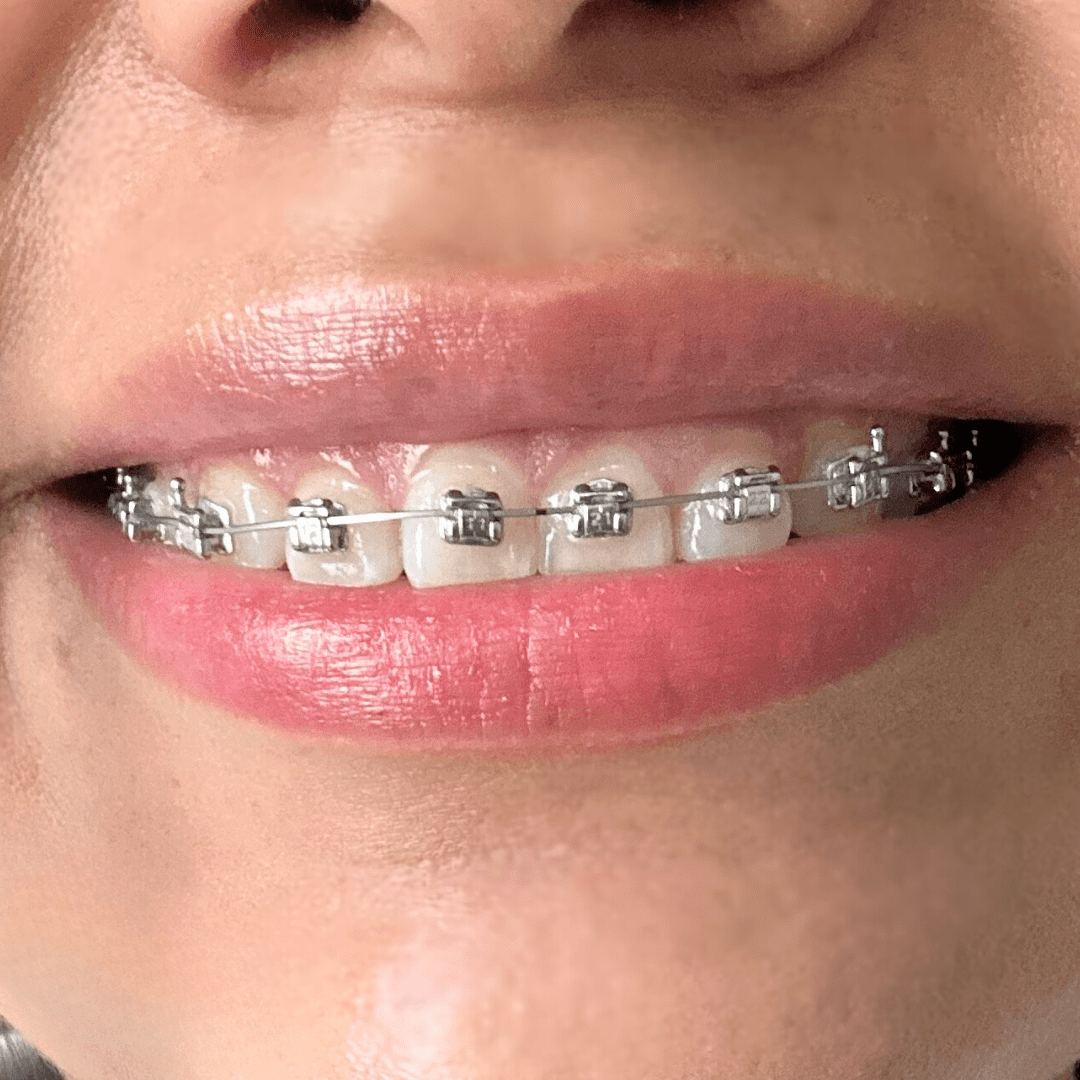 ortodoncia rápida Enamel