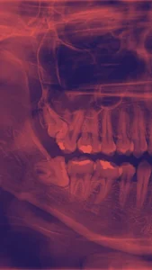 EXTRACCIONES DE MUELAS DEL JUICIO ENAMEL CLINICA