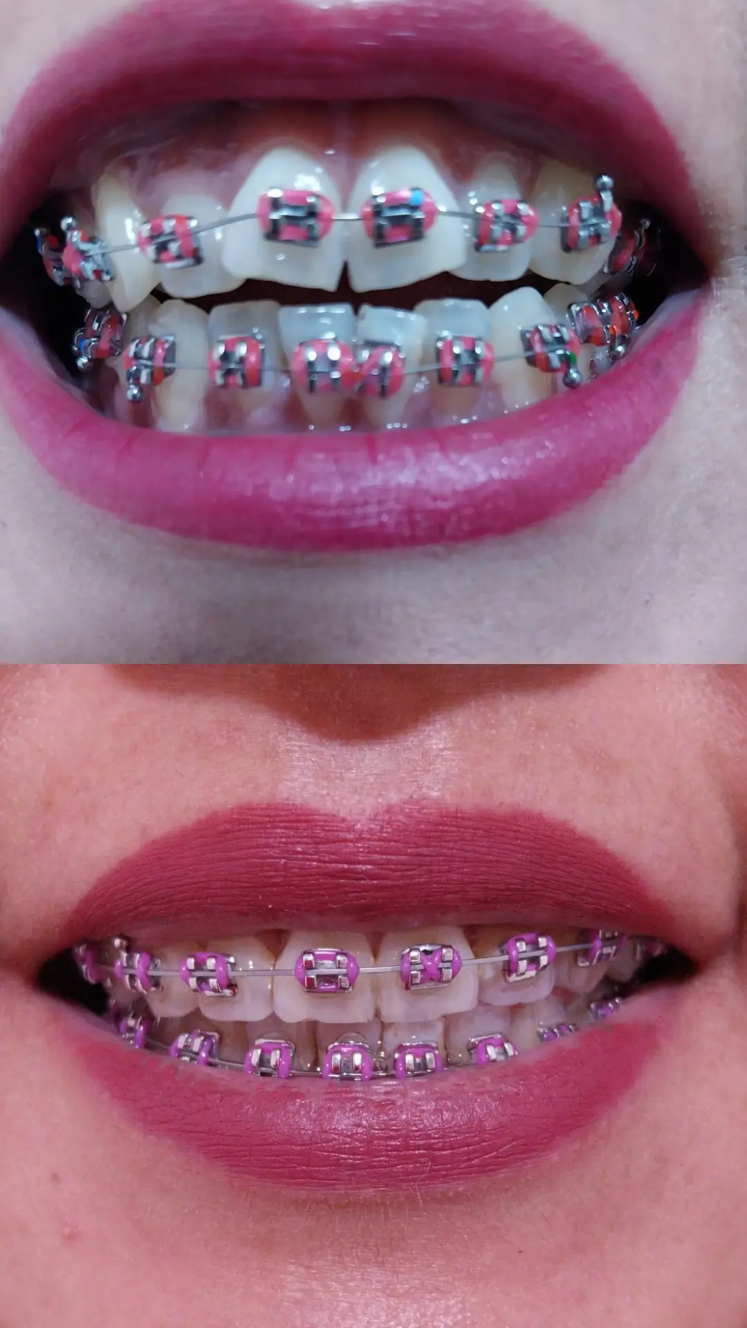 Tratamiento ortodoncia metálica en Ñuñoa