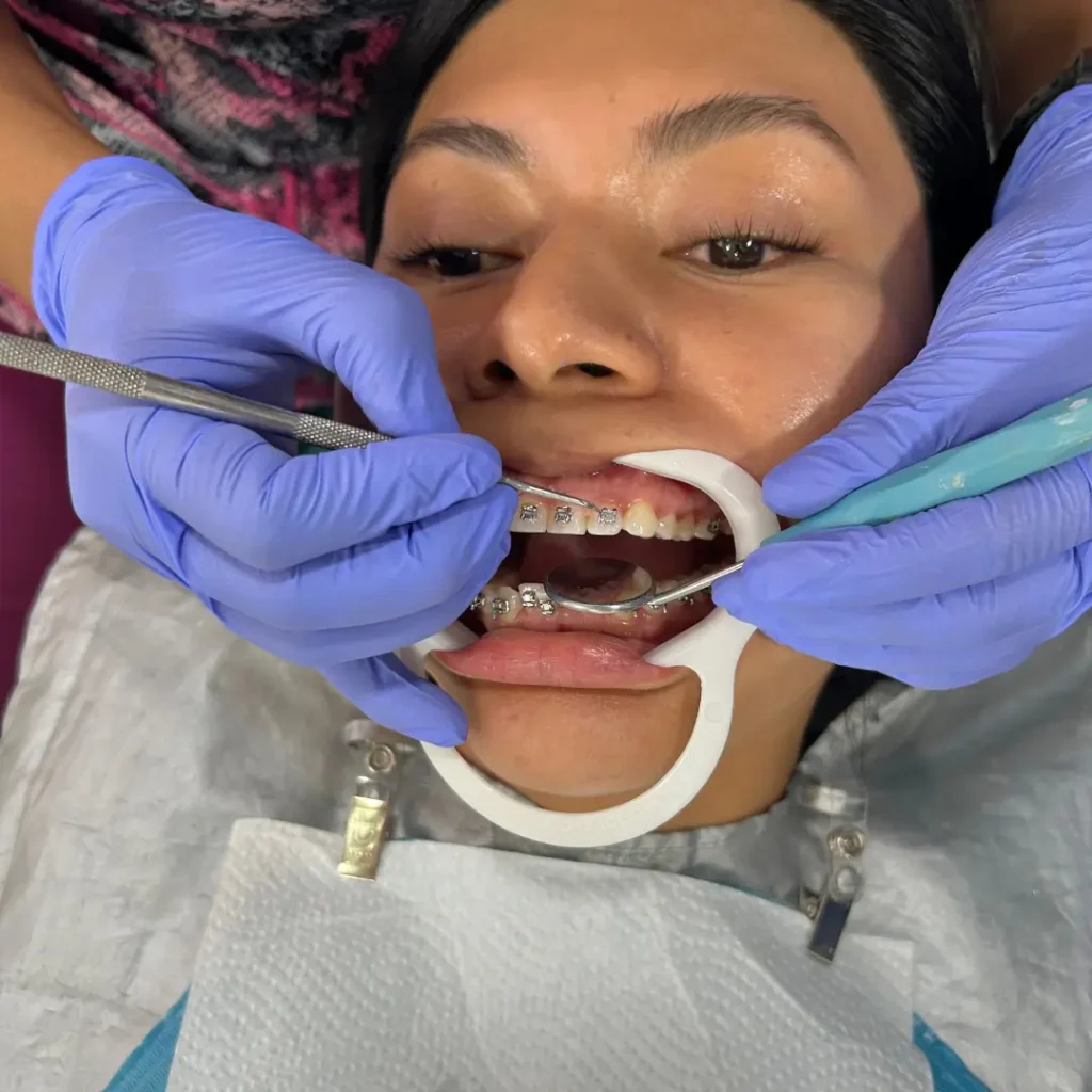 Ortodoncia rápida,ortodoncia en ñuñoa