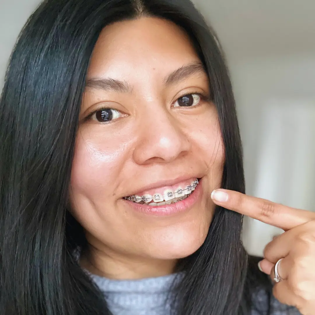 Duración de ortodoncia en Clínica Enamel