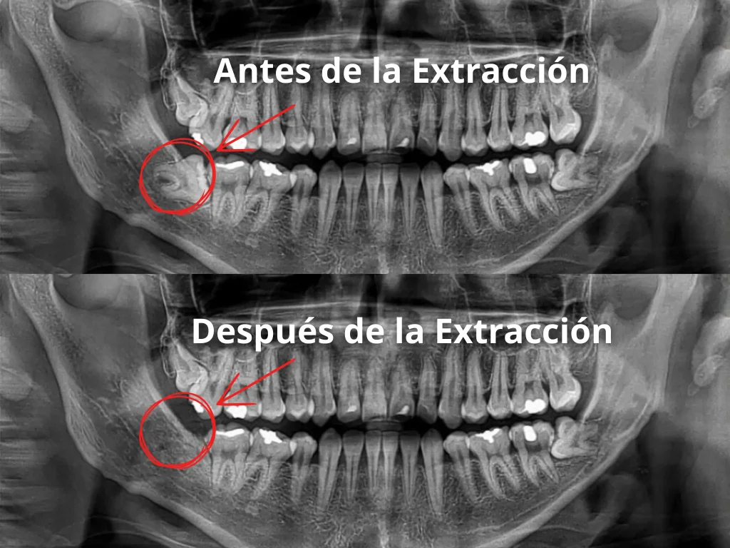 Radiografía antes y después de la extracción de una muela del juicio impactada en la Clínica Dental Enamel de Ñuñoa, mostrando el éxito del procedimiento.