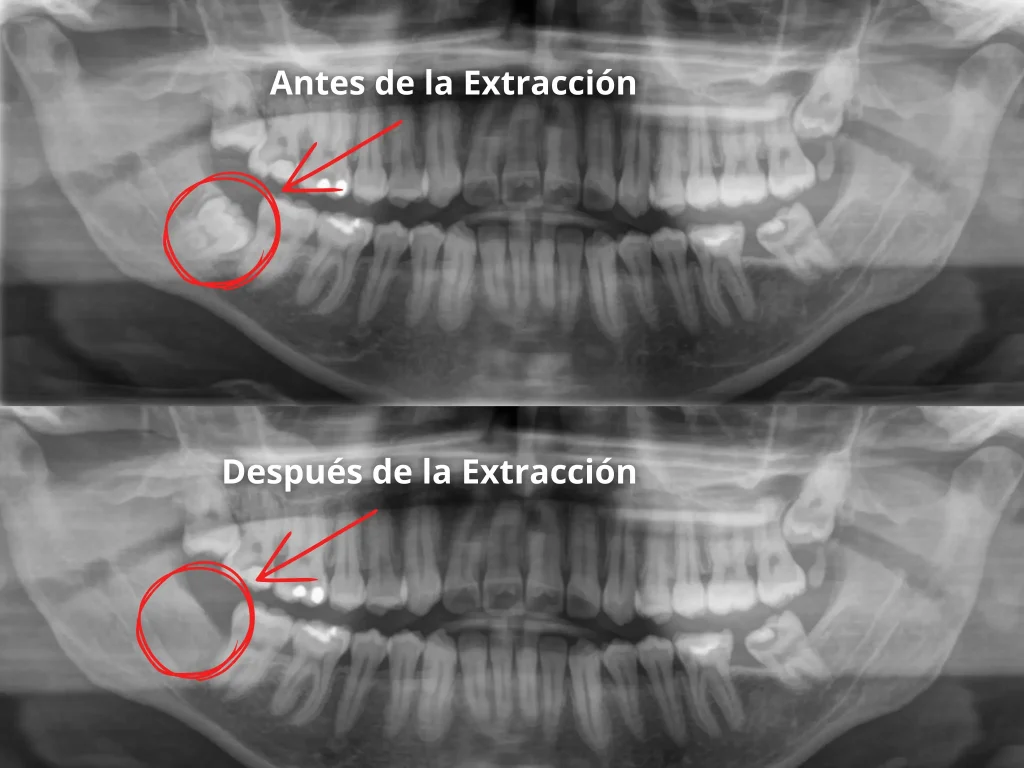Radiografía panorámica mostrando el antes y después de la exitosa extracción de una muela del juicio inferior impactada en la Clínica Dental Enamel de Ñuñoa.